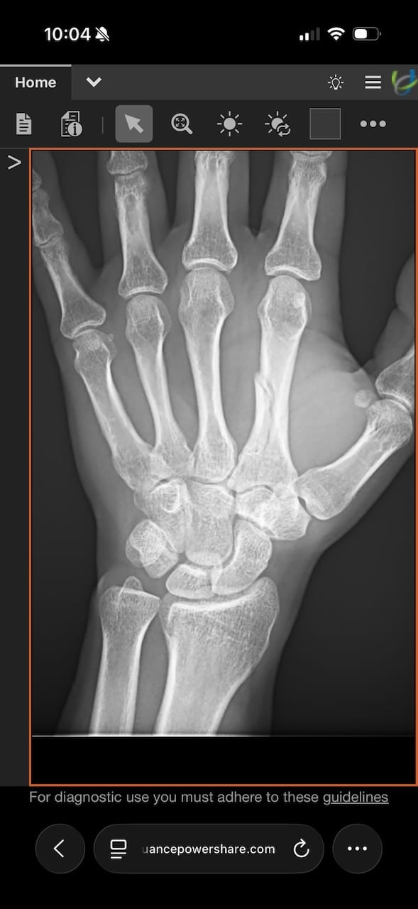 X-ray of my broken hand from UCHealth